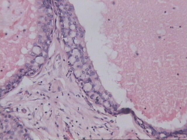 Carcinoma intraductal de Fisher - <div style=